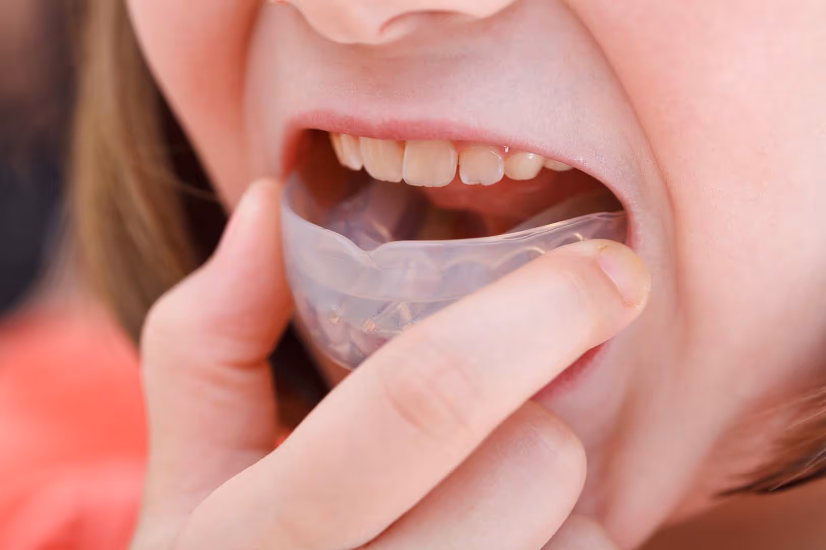 correction of malocclusion by orthodontic trainer